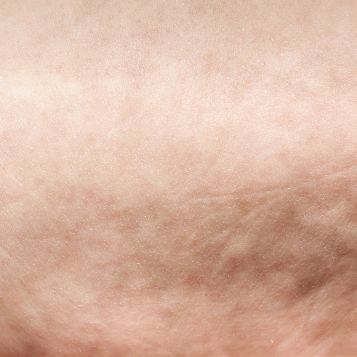 Can you treat cellulite