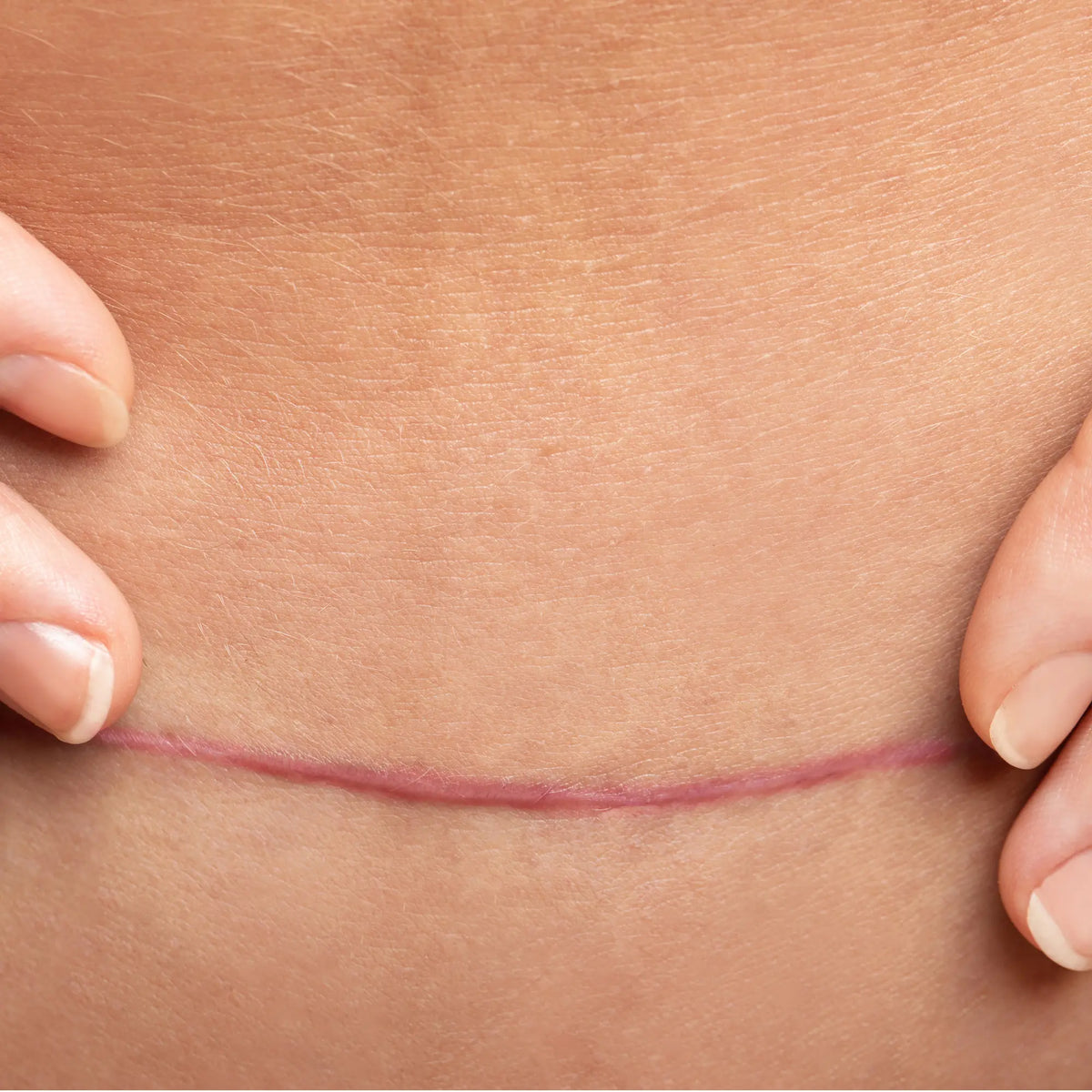 an image of a caesarean section scar healing