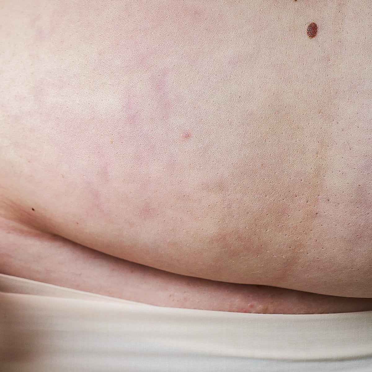What Is A C-Section Pouch & Can You Treat It?
