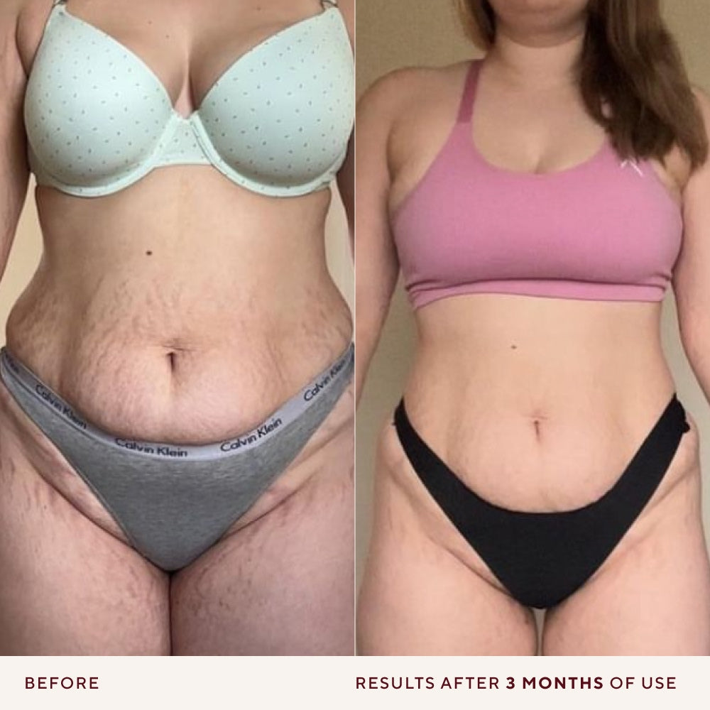 Before-and-after comparison of a woman's midsection showing skin improvement over 3 months of use of NAYDAYA's Body Saviour. The left 'before' panel shows a woman wearing a light mint green bra and gray Calvin Klein underwear.