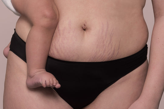 The Lowdown On Pregnancy Stretch Marks