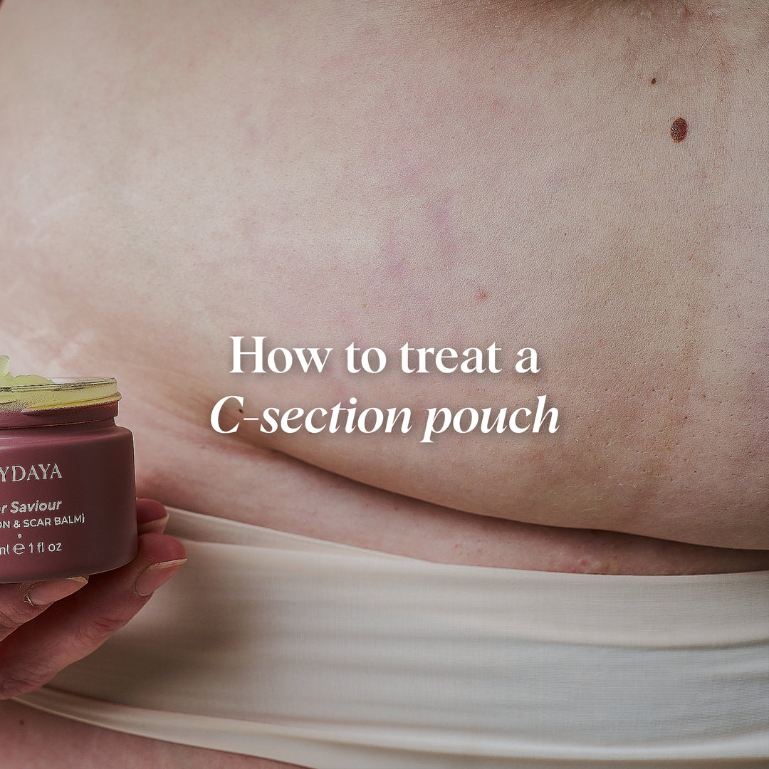 What Is A C-Section Pouch & Can You Treat It?