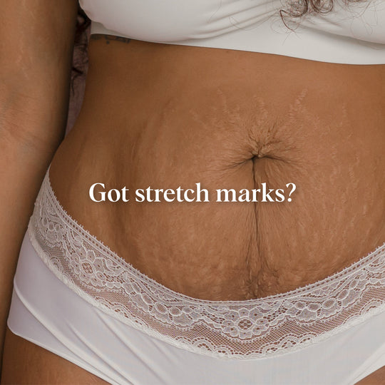 Stretch Marks: Five Things You Didn’t Know
