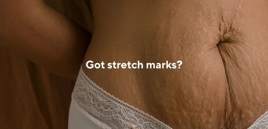 5 things you need to know about stretch marks