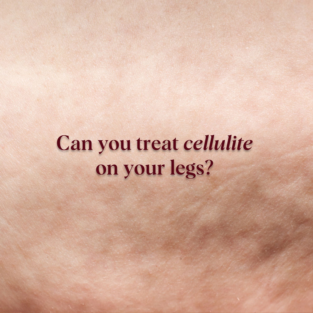 Can You Treat Cellulite on Your Legs?