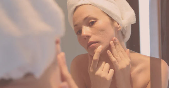 Pregnancy and Post-Pregnancy Acne