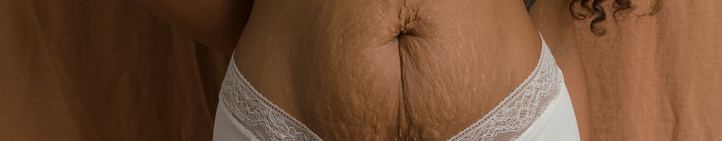 natural skincare for stretch marks 