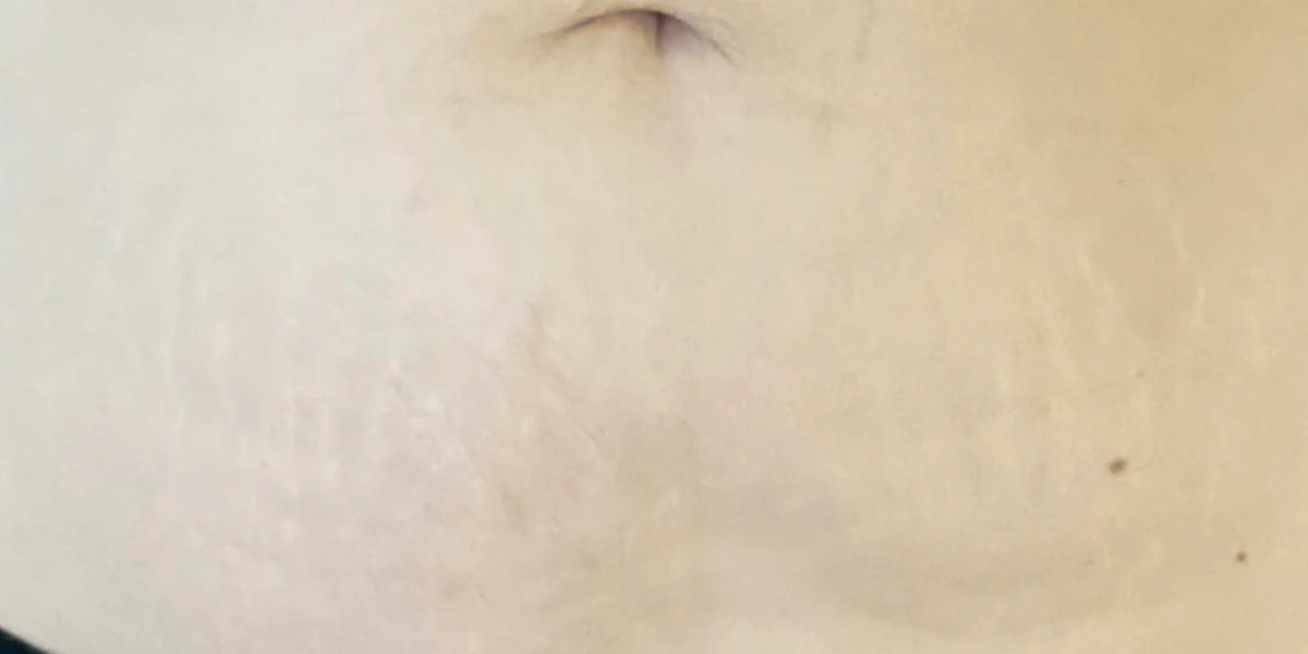 Close-up of a person's stomach skin showing stretch marks improvement after using naydayas body saviour.