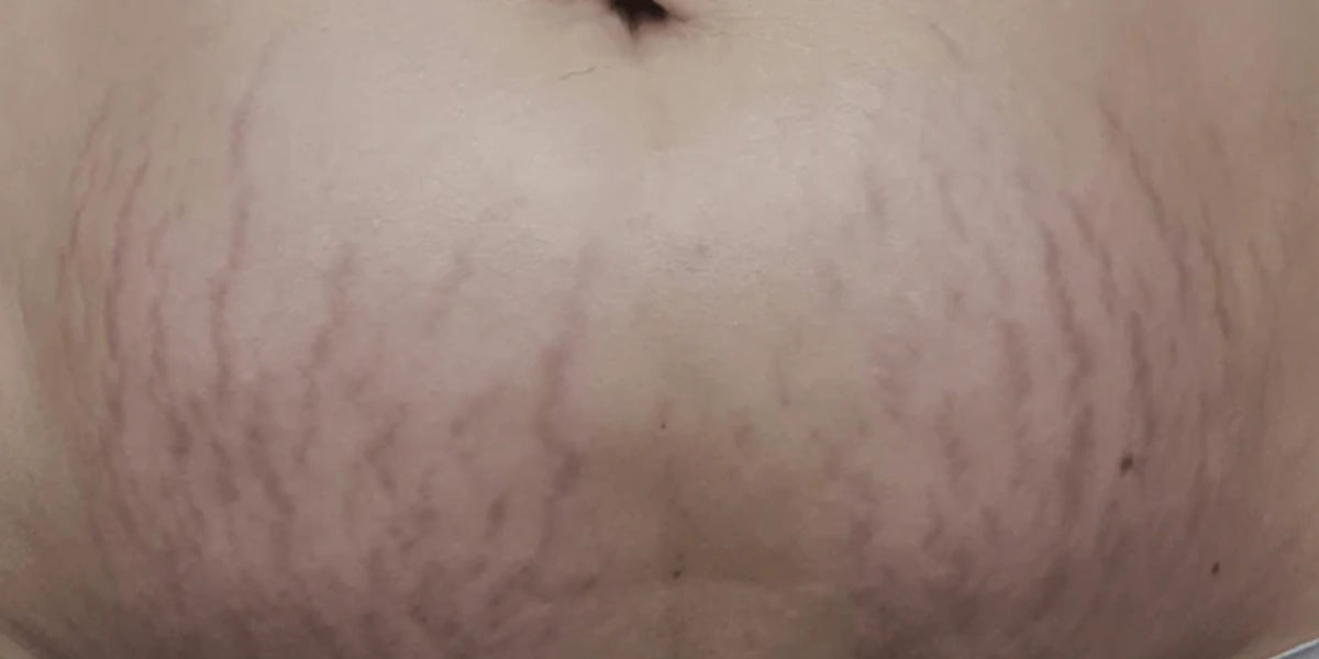 Close-up of a human torso showing stretch marks and skin texture on the abdomen before using naydayas body saviour.
