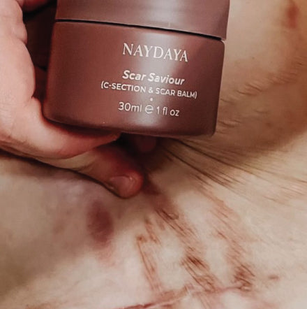 My scar is barely there